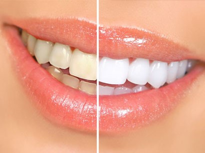 Teeth Veneers