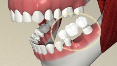 Dental Bridge