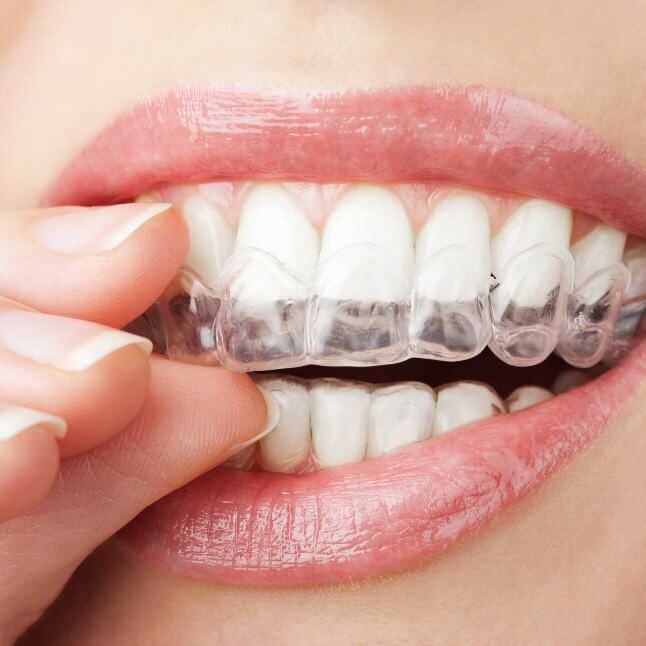 Invisalign trays