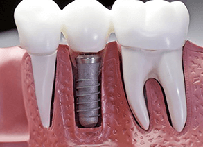 Dental Implant Near Me in Riverbank, CA